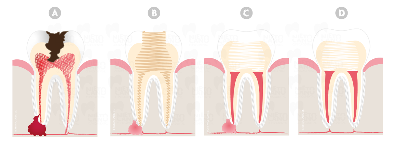 Fases de una endodoncia
